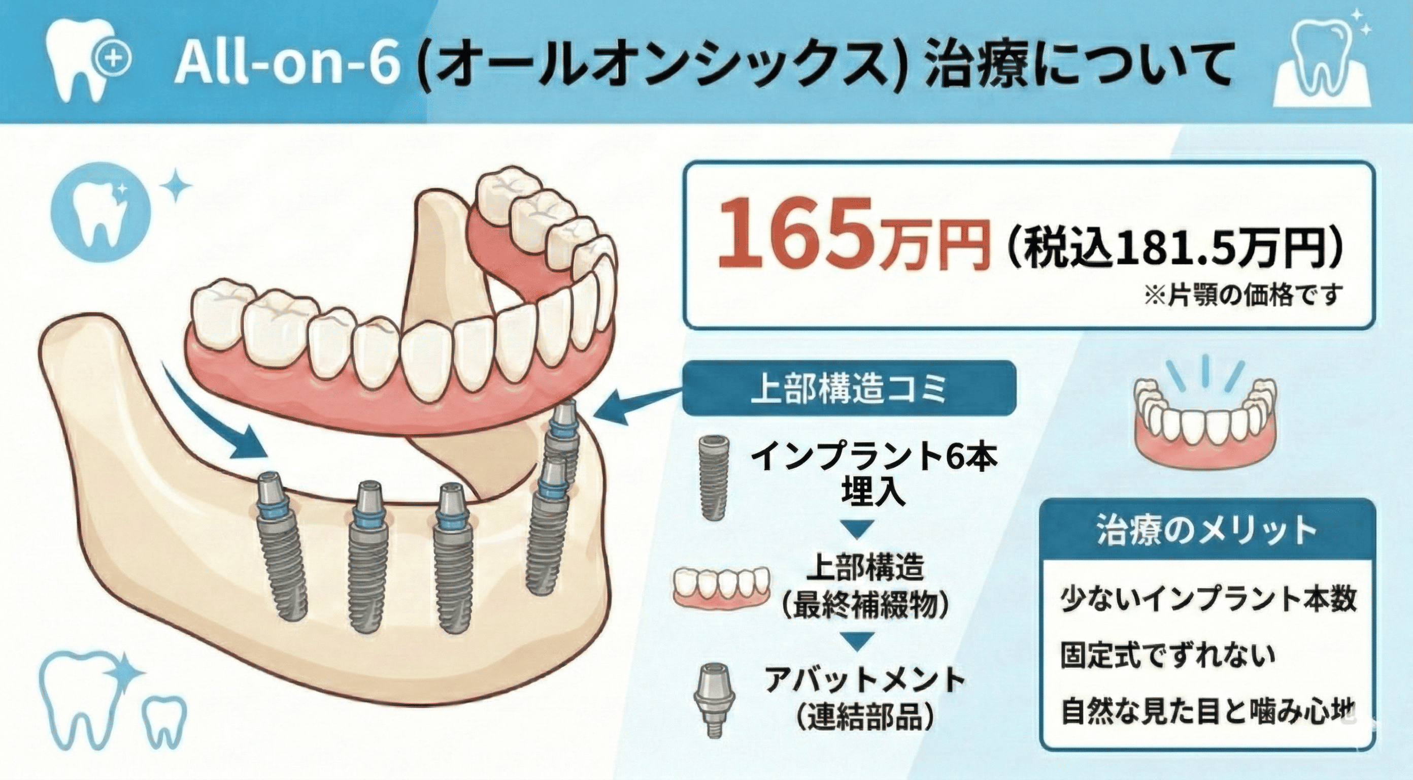 All-on-6料金 165万円（税込181.5万円）